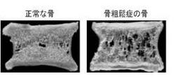 骨粗しょう症①.jpg